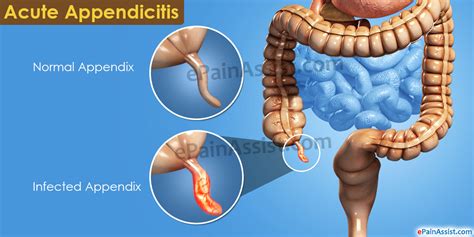 apendicita acuta|Appendizitis